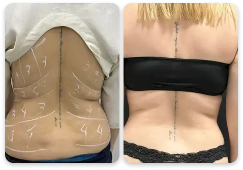 Antes e depois — lombar e flancos
