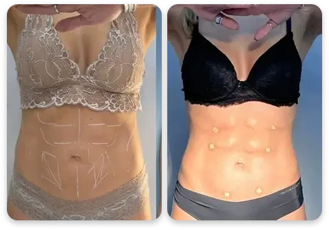 Antes e depois — protocolo estético feminino