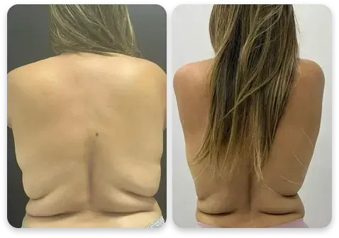 Antes e depois — costas femininas