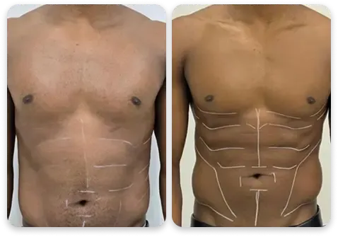 Antes e depois — abdômen masculino com marcação