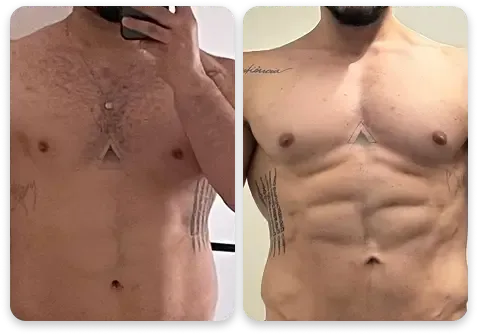 Antes e depois — abdômen masculino definido