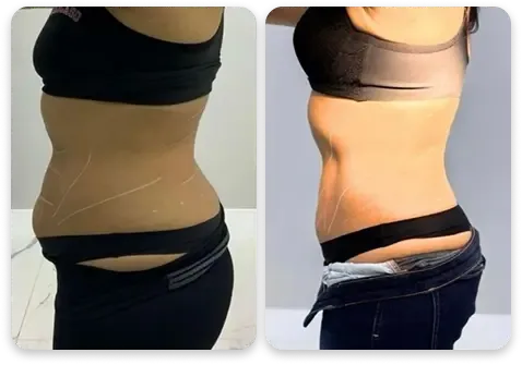 Antes e depois — abdômen feminino